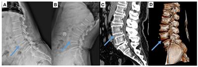 Efficacy of Single-Position Oblique Lateral Interbody Fusion Combined With Percutaneous Pedicle Screw Fixation in Treating Degenerative Lumbar Spondylolisthesis: A Cohort Study